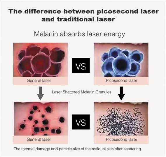 เทคนิคลบรอยสักด้วยเลเซอร์ Picosecond Laser มีจุดเด่นอย่างไร ?