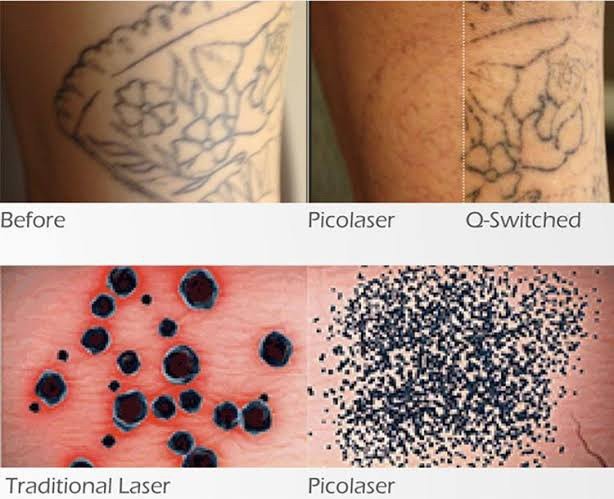 เทคนิคลบรอยสักด้วยเลเซอร์ Picosecond Laser มีจุดเด่นอย่างไร ? เทคนิคลบรอยสักด้วยเลเซอร์ Picosecond Laser มีจุดเด่นอย่างไร ?