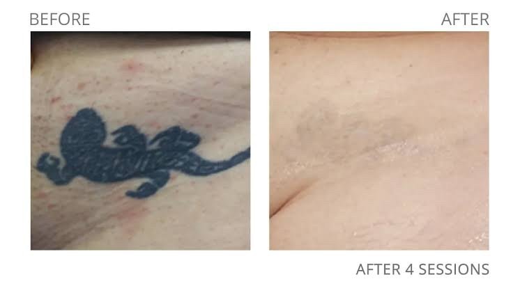 เทคนิคลบรอยสักด้วยเลเซอร์ Picosecond Laser มีจุดเด่นอย่างไร ? เทคนิคลบรอยสักด้วยเลเซอร์ Picosecond Laser มีจุดเด่นอย่างไร ?