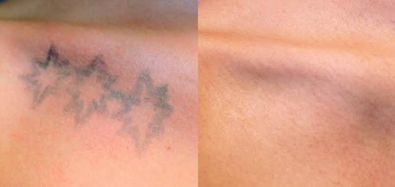 เทคนิคลบรอยสักด้วยเลเซอร์ Picosecond Laser มีจุดเด่นอย่างไร ? เทคนิคลบรอยสักด้วยเลเซอร์ Picosecond Laser มีจุดเด่นอย่างไร ?