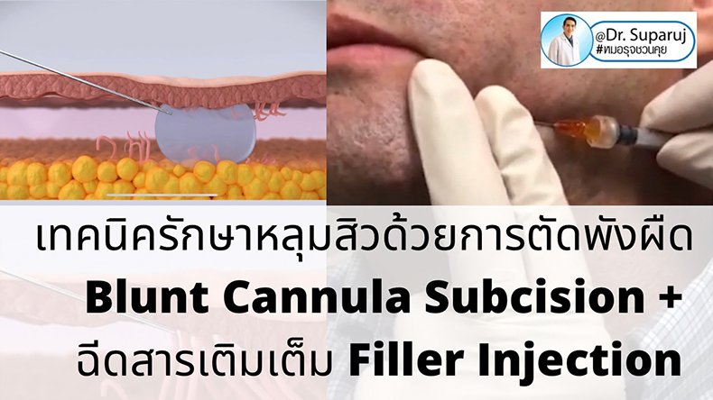 เทคนิคดูแลหลุมสิวด้วยการตัดพังผืดหลุมสิว Blunt Cannula Subcision ร่วมกับการฉีดสารเติมเต็ม Filler Injection