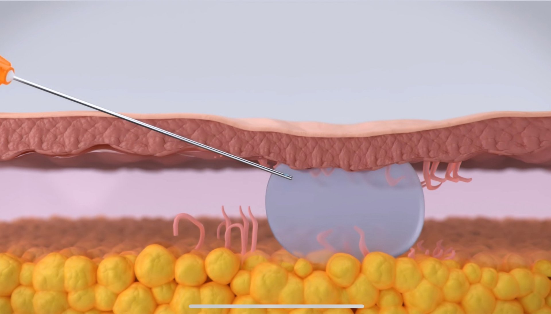 เทคนิคดูแลหลุมสิวด้วยการตัดพังผืดหลุมสิว Blunt Cannula Subcision ร่วมกับการฉีดสารเติมเต็ม Filler Injection เทคนิคดูแลหลุมสิวด้วยการตัดพังผืดหลุมสิว Blunt Cannula Subcision ร่วมกับการฉีดสารเติมเต็ม Filler Injection
