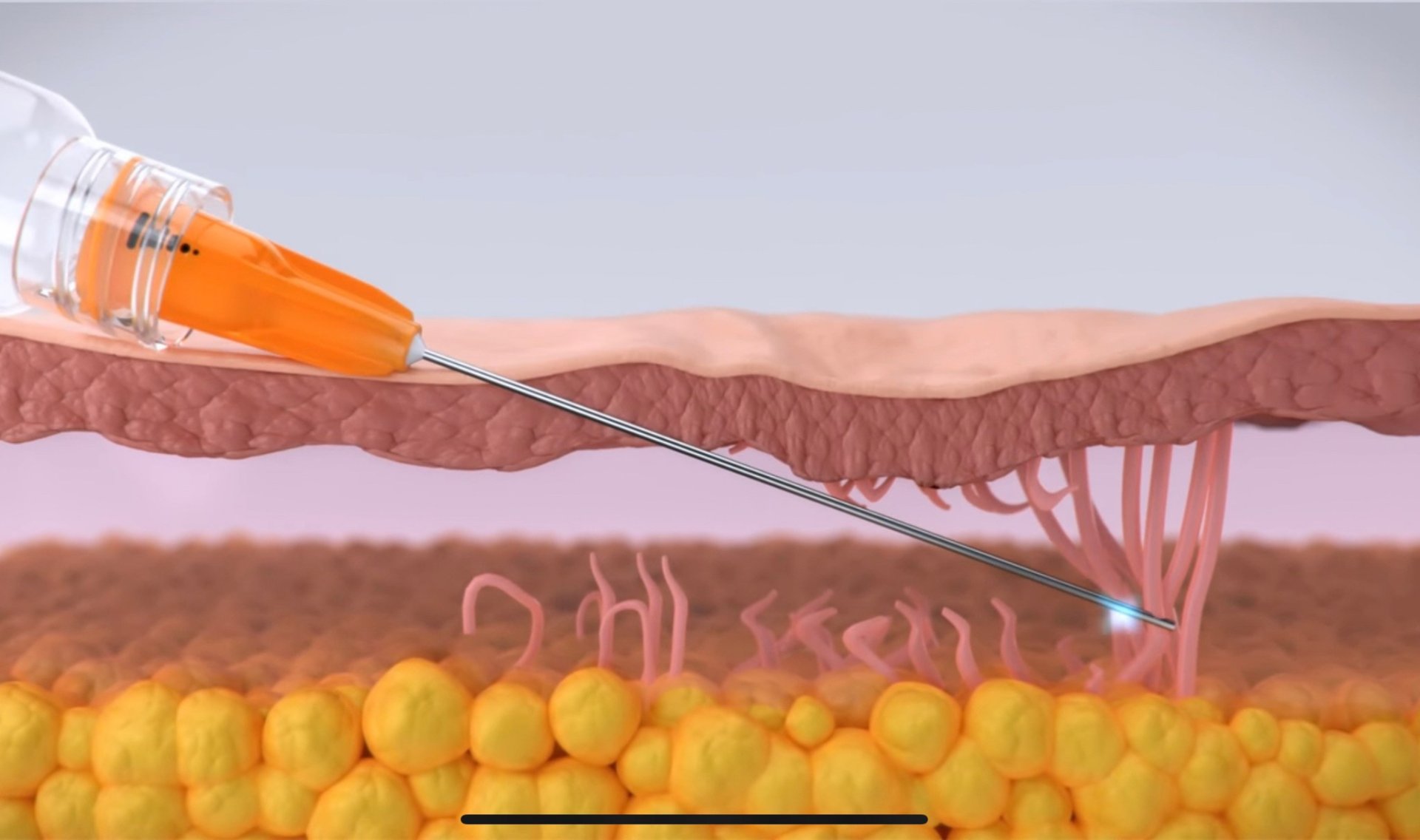 เทคนิคดูแลหลุมสิวด้วยการตัดพังผืดหลุมสิว Blunt Cannula Subcision ร่วมกับการฉีดสารเติมเต็ม Filler Injection