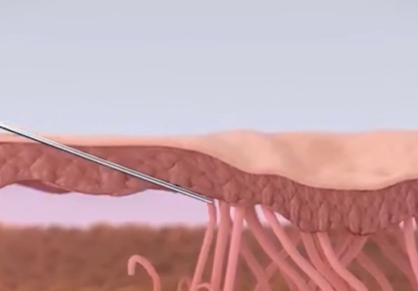 เทคนิคดูแลหลุมสิวด้วยการตัดพังผืดหลุมสิว Blunt Cannula Subcision ร่วมกับการฉีดสารเติมเต็ม Filler Injection เทคนิคดูแลหลุมสิวด้วยการตัดพังผืดหลุมสิว Blunt Cannula Subcision ร่วมกับการฉีดสารเติมเต็ม Filler Injection