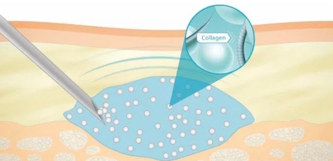 เทคนิคดูแลหลุมสิวด้วยการตัดพังผืดหลุมสิว Blunt Cannula Subcision ร่วมกับการฉีดสารเติมเต็ม Filler Injection เทคนิคดูแลหลุมสิวด้วยการตัดพังผืดหลุมสิว Blunt Cannula Subcision ร่วมกับการฉีดสารเติมเต็ม Filler Injection
