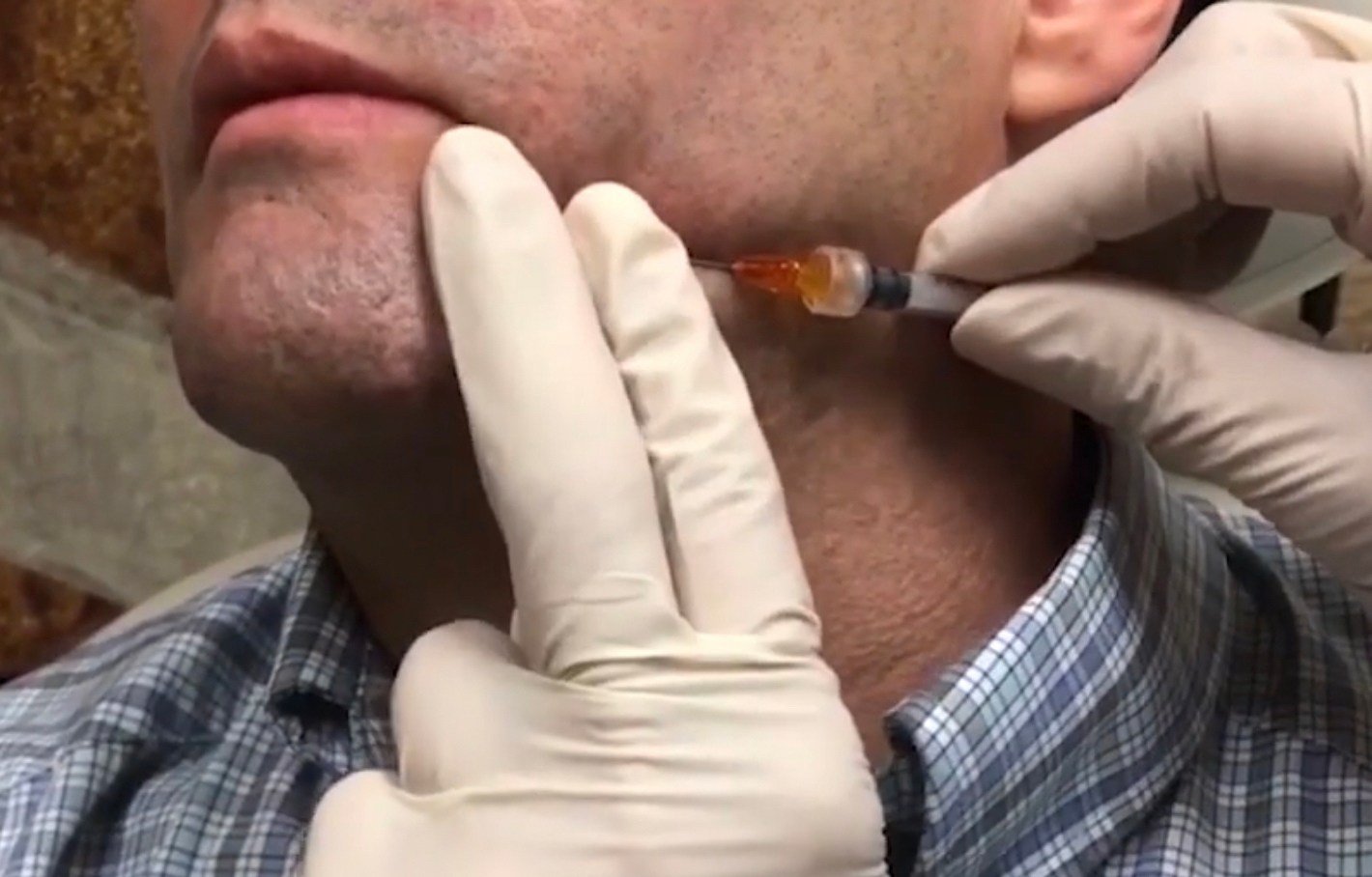 เทคนิคดูแลหลุมสิวด้วยการตัดพังผืดหลุมสิว Blunt Cannula Subcision ร่วมกับการฉีดสารเติมเต็ม Filler Injection เทคนิคดูแลหลุมสิวด้วยการตัดพังผืดหลุมสิว Blunt Cannula Subcision ร่วมกับการฉีดสารเติมเต็ม Filler Injection