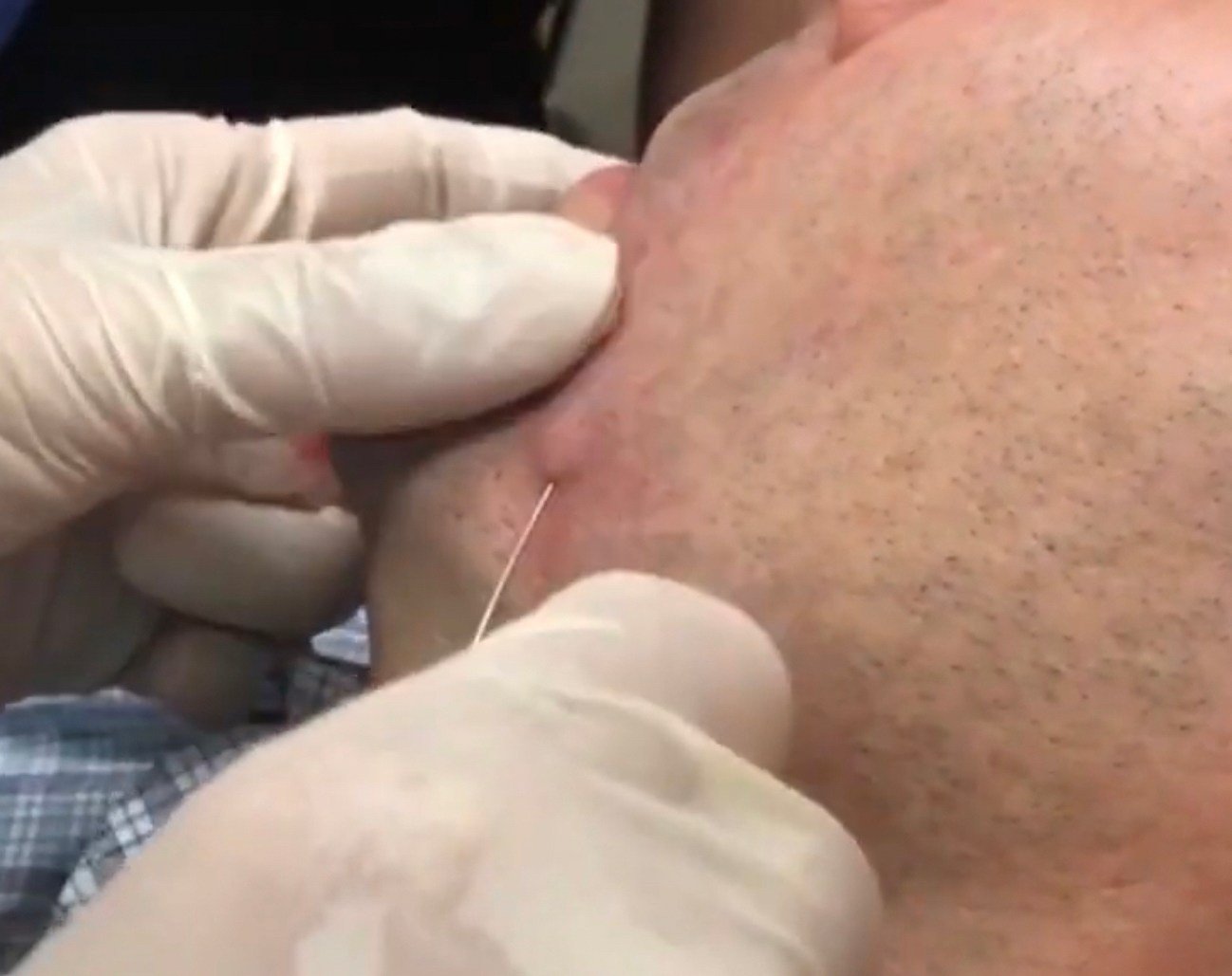 เทคนิคดูแลหลุมสิวด้วยการตัดพังผืดหลุมสิว Blunt Cannula Subcision ร่วมกับการฉีดสารเติมเต็ม Filler Injection เทคนิคดูแลหลุมสิวด้วยการตัดพังผืดหลุมสิว Blunt Cannula Subcision ร่วมกับการฉีดสารเติมเต็ม Filler Injection