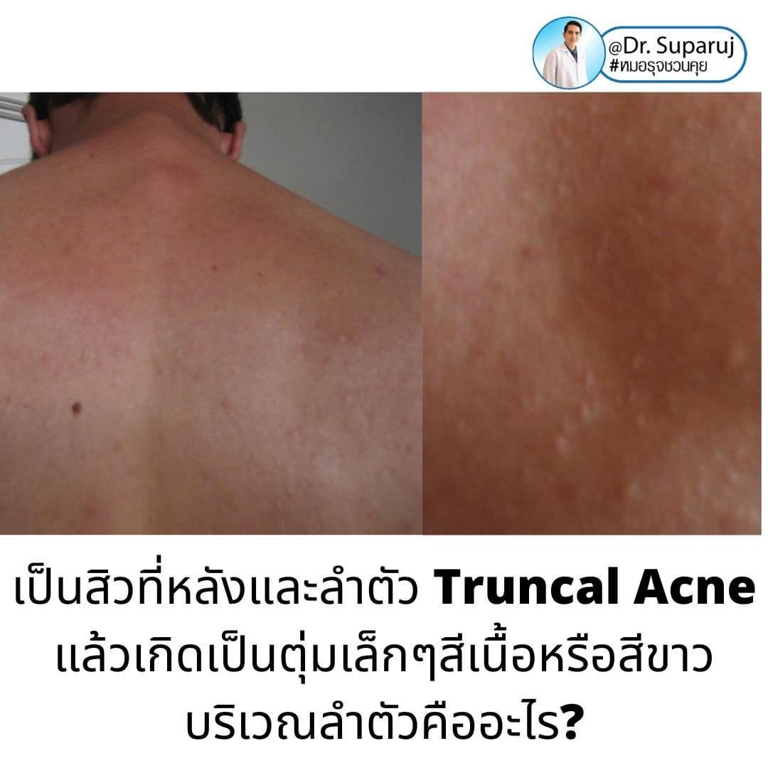 เป็นสิวที่หลังและลำตัว Truncal แล้วเกิดเป็นตุ่มเล็กๆสีเนื้อหรือสีขาว บริเวณลำตัวส่วนบนและไหล่คืออะไร? : แผลเป็นสิวชนิดตุ่มนูน Papular Acne Scar เป็นสิวที่หลังและลำตัว Truncal แล้วเกิดเป็นตุ่มเล็กๆสีเนื้อหรือสีขาว บริเวณลำตัวส่วนบนและไหล่คืออะไร? : แผลเป็นสิวชนิดตุ่มนูน Papular Acne Scar
