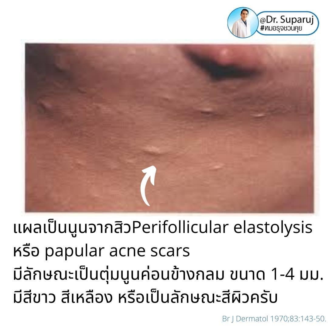 เป็นสิวที่หลังและลำตัว Truncal แล้วเกิดเป็นตุ่มเล็กๆสีเนื้อหรือสีขาว บริเวณลำตัวส่วนบนและไหล่คืออะไร? : แผลเป็นสิวชนิดตุ่มนูน Papular Acne Scar เป็นสิวที่หลังและลำตัว Truncal แล้วเกิดเป็นตุ่มเล็กๆสีเนื้อหรือสีขาว บริเวณลำตัวส่วนบนและไหล่คืออะไร? : แผลเป็นสิวชนิดตุ่มนูน Papular Acne Scar