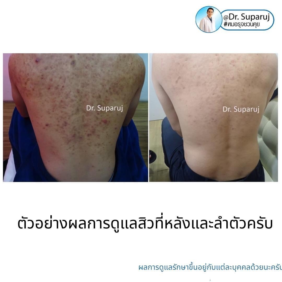 เป็นสิวที่หลังและลำตัว Truncal แล้วเกิดเป็นตุ่มเล็กๆสีเนื้อหรือสีขาว บริเวณลำตัวส่วนบนและไหล่คืออะไร? : แผลเป็นสิวชนิดตุ่มนูน Papular Acne Scar เป็นสิวที่หลังและลำตัว Truncal แล้วเกิดเป็นตุ่มเล็กๆสีเนื้อหรือสีขาว บริเวณลำตัวส่วนบนและไหล่คืออะไร? : แผลเป็นสิวชนิดตุ่มนูน Papular Acne Scar