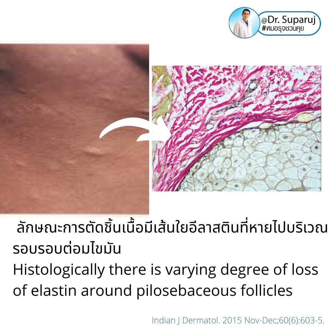 เป็นสิวที่หลังและลำตัว Truncal แล้วเกิดเป็นตุ่มเล็กๆสีเนื้อหรือสีขาว บริเวณลำตัวส่วนบนและไหล่คืออะไร? : แผลเป็นสิวชนิดตุ่มนูน Papular Acne Scar เป็นสิวที่หลังและลำตัว Truncal แล้วเกิดเป็นตุ่มเล็กๆสีเนื้อหรือสีขาว บริเวณลำตัวส่วนบนและไหล่คืออะไร? : แผลเป็นสิวชนิดตุ่มนูน Papular Acne Scar