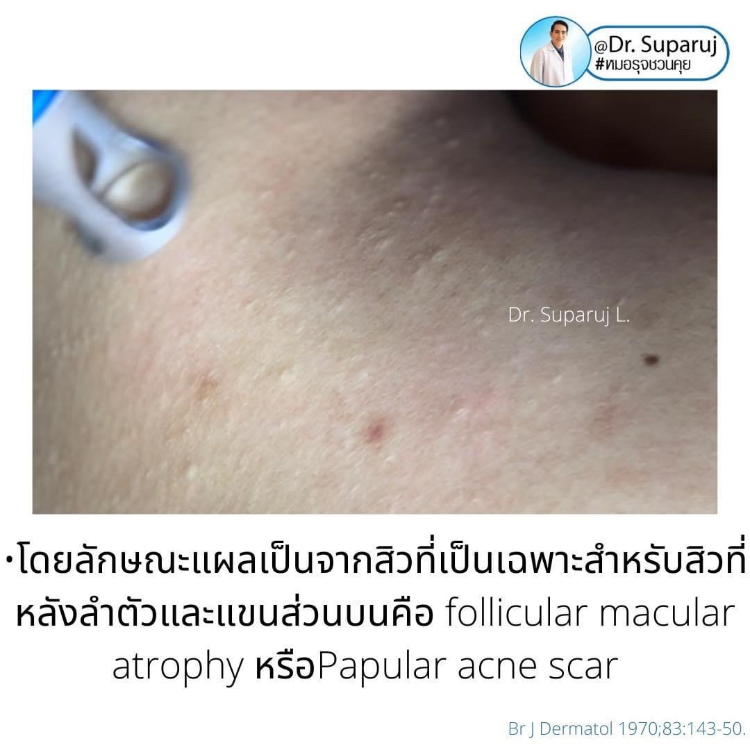 เป็นสิวที่หลังและลำตัว Truncal แล้วเกิดเป็นตุ่มเล็กๆสีเนื้อหรือสีขาว บริเวณลำตัวส่วนบนและไหล่คืออะไร? : แผลเป็นสิวชนิดตุ่มนูน Papular Acne Scar เป็นสิวที่หลังและลำตัว Truncal แล้วเกิดเป็นตุ่มเล็กๆสีเนื้อหรือสีขาว บริเวณลำตัวส่วนบนและไหล่คืออะไร? : แผลเป็นสิวชนิดตุ่มนูน Papular Acne Scar