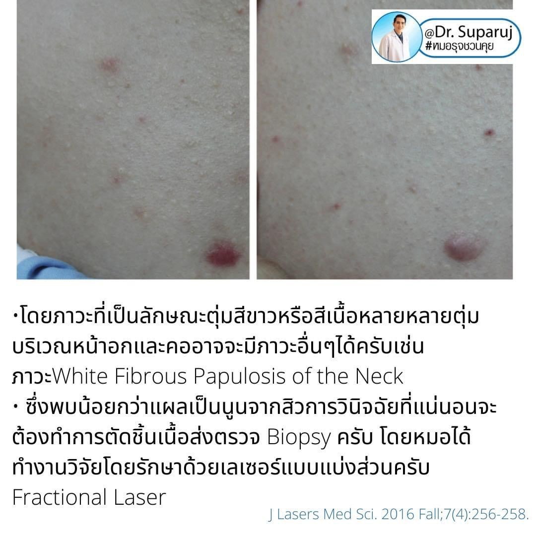 เป็นสิวที่หลังและลำตัว Truncal แล้วเกิดเป็นตุ่มเล็กๆสีเนื้อหรือสีขาว บริเวณลำตัวส่วนบนและไหล่คืออะไร? : แผลเป็นสิวชนิดตุ่มนูน Papular Acne Scar เป็นสิวที่หลังและลำตัว Truncal แล้วเกิดเป็นตุ่มเล็กๆสีเนื้อหรือสีขาว บริเวณลำตัวส่วนบนและไหล่คืออะไร? : แผลเป็นสิวชนิดตุ่มนูน Papular Acne Scar