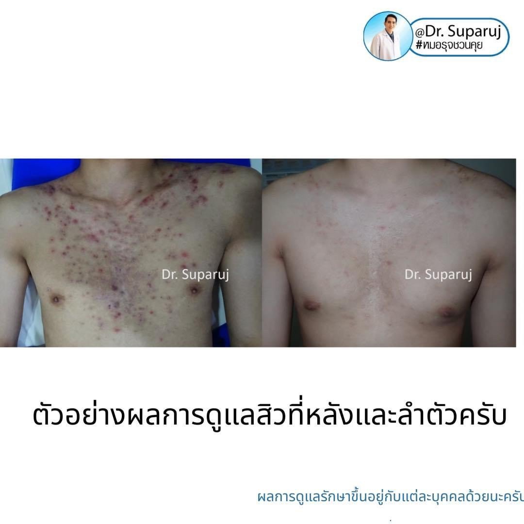 เป็นสิวที่หลังและลำตัว Truncal แล้วเกิดเป็นตุ่มเล็กๆสีเนื้อหรือสีขาว บริเวณลำตัวส่วนบนและไหล่คืออะไร? : แผลเป็นสิวชนิดตุ่มนูน Papular Acne Scar เป็นสิวที่หลังและลำตัว Truncal แล้วเกิดเป็นตุ่มเล็กๆสีเนื้อหรือสีขาว บริเวณลำตัวส่วนบนและไหล่คืออะไร? : แผลเป็นสิวชนิดตุ่มนูน Papular Acne Scar