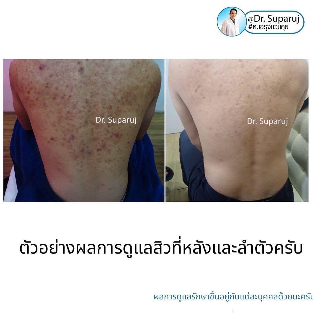 เป็นสิวที่หลังและลำตัว Truncal แล้วเกิดเป็นตุ่มเล็กๆสีเนื้อหรือสีขาว บริเวณลำตัวส่วนบนและไหล่คืออะไร? : แผลเป็นสิวชนิดตุ่มนูน Papular Acne Scar เป็นสิวที่หลังและลำตัว Truncal แล้วเกิดเป็นตุ่มเล็กๆสีเนื้อหรือสีขาว บริเวณลำตัวส่วนบนและไหล่คืออะไร? : แผลเป็นสิวชนิดตุ่มนูน Papular Acne Scar