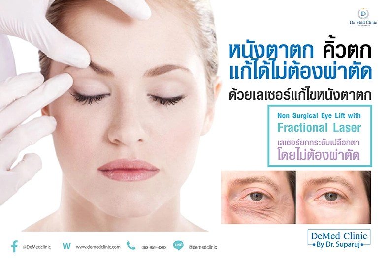 หนังตาหย่อนคล้อยเกิดจากอะไร & เทคนิคดูแลหนังตาหย่อนคล้อยโดยไม่ต้องผ่าตัด หนังตาหย่อนคล้อยเกิดจากอะไร & เทคนิคดูแลหนังตาหย่อนคล้อยโดยไม่ต้องผ่าตัด