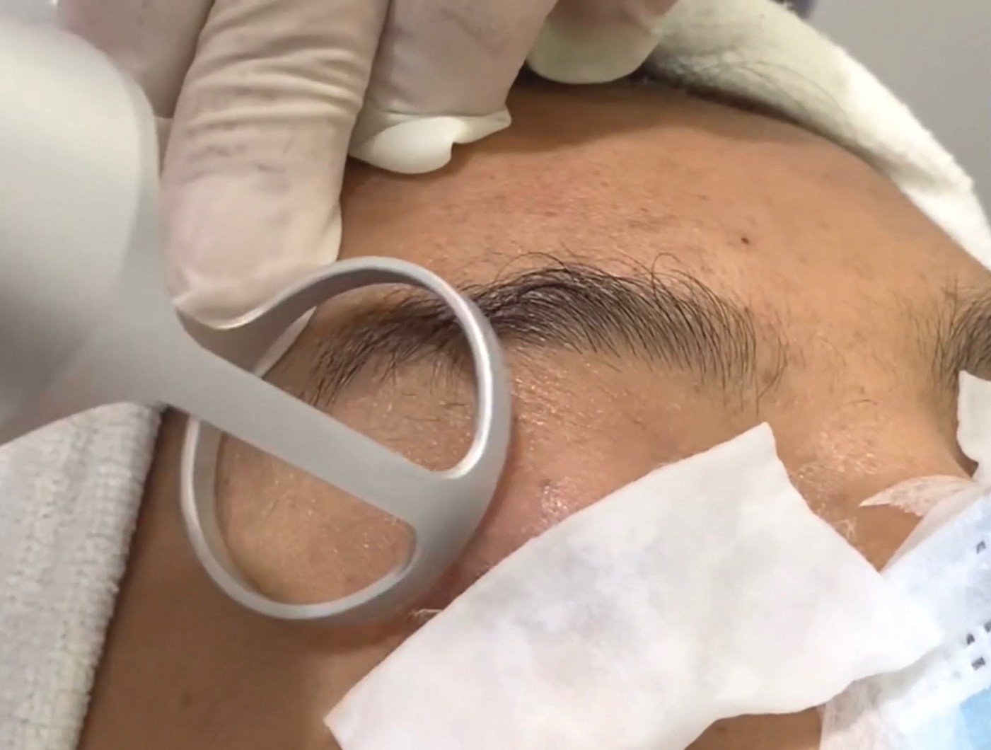 หนังตาหย่อนคล้อยเกิดจากอะไร & เทคนิคดูแลหนังตาหย่อนคล้อยโดยไม่ต้องผ่าตัด หนังตาหย่อนคล้อยเกิดจากอะไร & เทคนิคดูแลหนังตาหย่อนคล้อยโดยไม่ต้องผ่าตัด