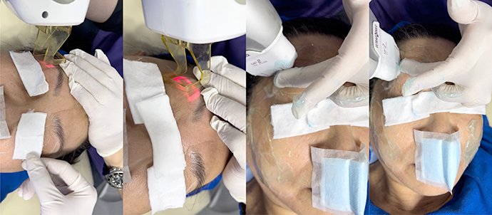 หนังตาหย่อนคล้อยเกิดจากอะไร & เทคนิคดูแลหนังตาหย่อนคล้อยโดยไม่ต้องผ่าตัด หนังตาหย่อนคล้อยเกิดจากอะไร & เทคนิคดูแลหนังตาหย่อนคล้อยโดยไม่ต้องผ่าตัด