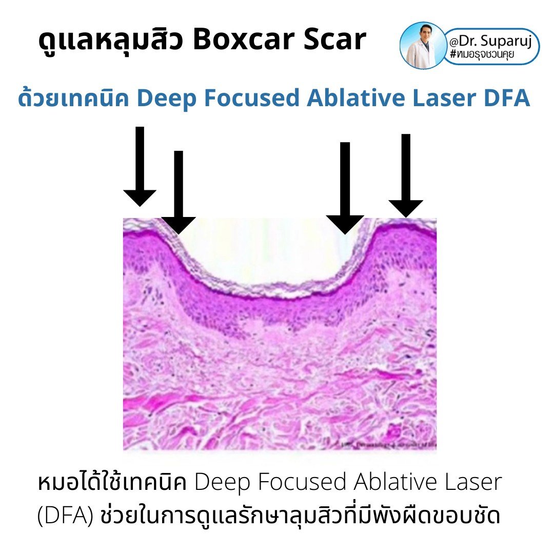 แนะนำเทคนิคดูแลหลุมสิว: เทคนิค Deep Focused Ablative Laser (DFA) ดูแลหลุมสิวลึกขอบชัดพังผืดหนา Boxcar Scar และ Linear scar แนะนำเทคนิคดูแลหลุมสิว: เทคนิค Deep Focused Ablative Laser (DFA) ดูแลหลุมสิวลึกขอบชัดพังผืดหนา Boxcar Scar และ Linear scar