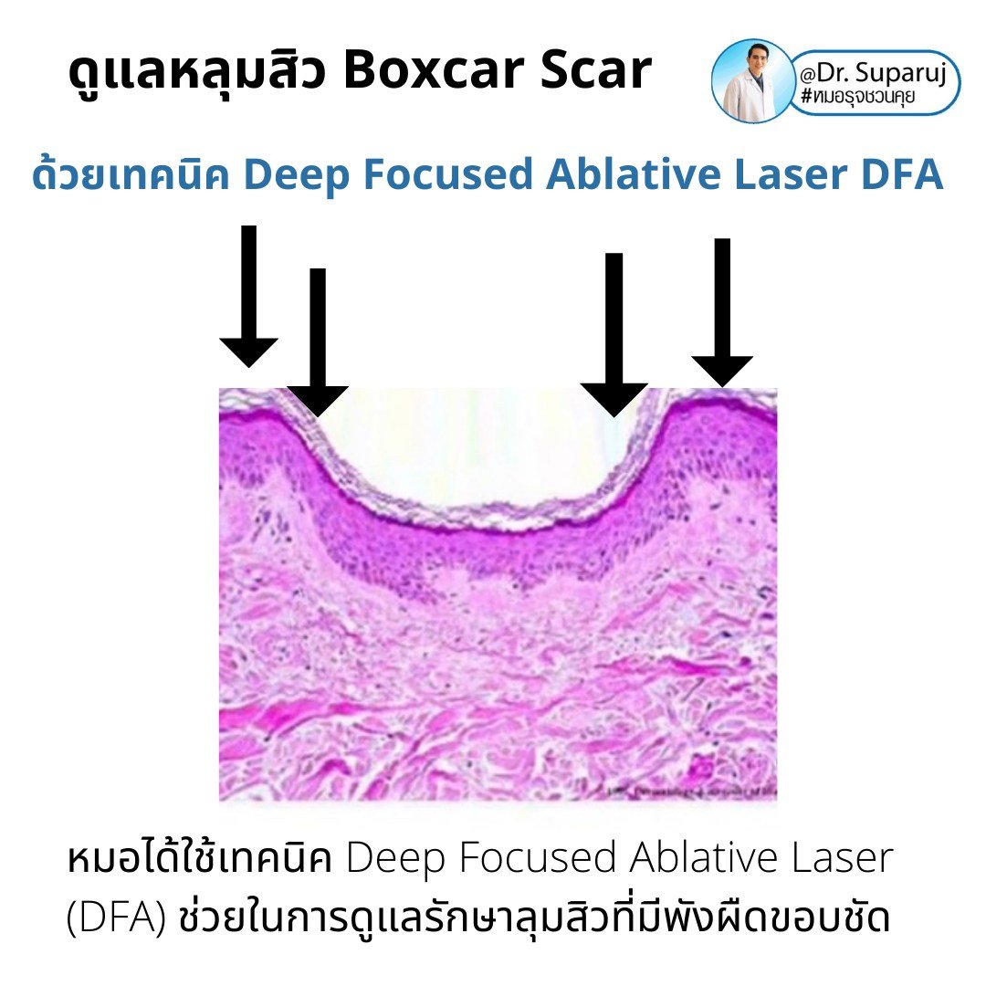 แนะนำเทคนิคดูแลหลุมสิว: เทคนิค Deep Focused Ablative Laser (DFA) ดูแลหลุมสิวลึกขอบชัดพังผืดหนา Boxcar Scar และ Linear scar