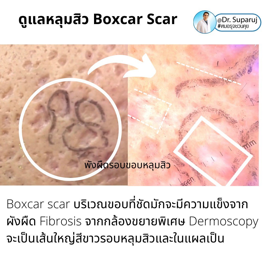 แนะนำเทคนิคดูแลหลุมสิว: เทคนิค Deep Focused Ablative Laser (DFA) ดูแลหลุมสิวลึกขอบชัดพังผืดหนา Boxcar Scar และ Linear scar แนะนำเทคนิคดูแลหลุมสิว: เทคนิค Deep Focused Ablative Laser (DFA) ดูแลหลุมสิวลึกขอบชัดพังผืดหนา Boxcar Scar และ Linear scar