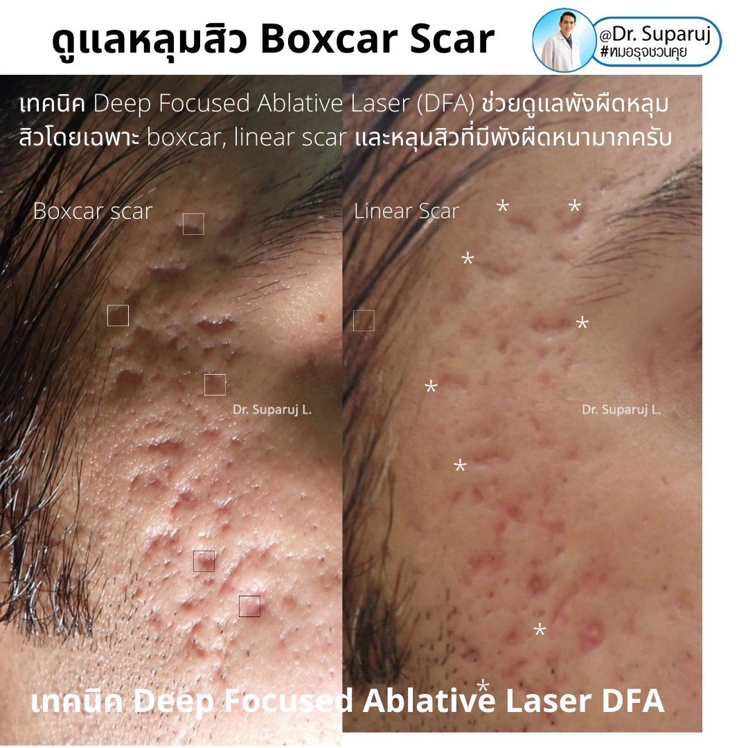 แนะนำเทคนิคดูแลหลุมสิว: เทคนิค Deep Focused Ablative Laser (DFA) ดูแลหลุมสิวลึกขอบชัดพังผืดหนา Boxcar Scar และ Linear scar แนะนำเทคนิคดูแลหลุมสิว: เทคนิค Deep Focused Ablative Laser (DFA) ดูแลหลุมสิวลึกขอบชัดพังผืดหนา Boxcar Scar และ Linear scar