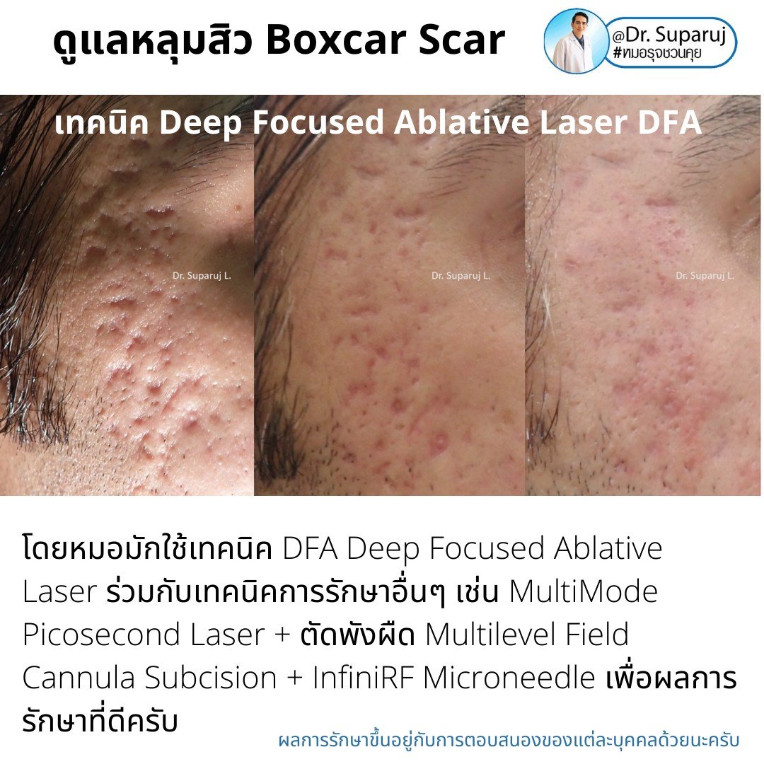 แนะนำเทคนิคดูแลหลุมสิว: เทคนิค Deep Focused Ablative Laser (DFA) ดูแลหลุมสิวลึกขอบชัดพังผืดหนา Boxcar Scar และ Linear scar แนะนำเทคนิคดูแลหลุมสิว: เทคนิค Deep Focused Ablative Laser (DFA) ดูแลหลุมสิวลึกขอบชัดพังผืดหนา Boxcar Scar และ Linear scar