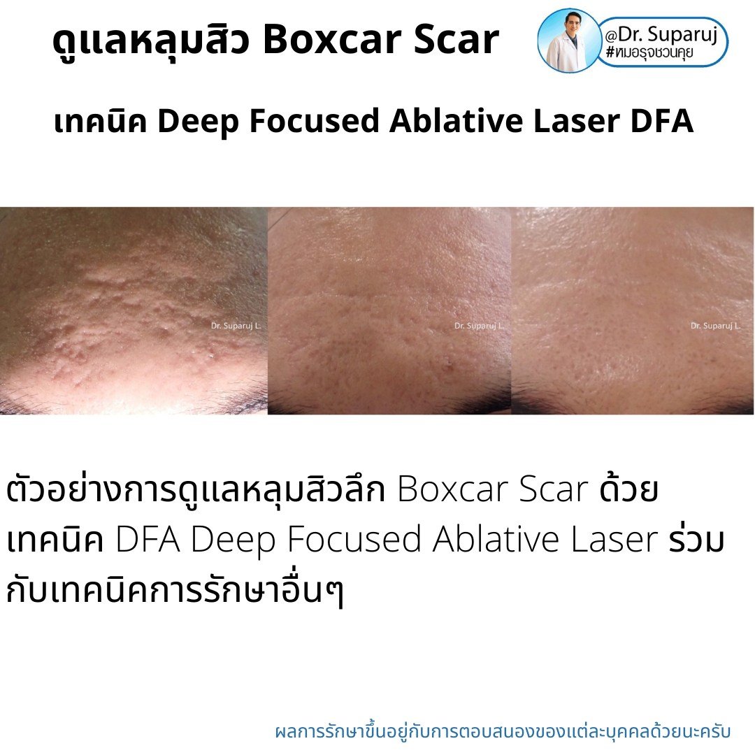 แนะนำเทคนิคดูแลหลุมสิว: เทคนิค Deep Focused Ablative Laser (DFA) ดูแลหลุมสิวลึกขอบชัดพังผืดหนา Boxcar Scar และ Linear scar แนะนำเทคนิคดูแลหลุมสิว: เทคนิค Deep Focused Ablative Laser (DFA) ดูแลหลุมสิวลึกขอบชัดพังผืดหนา Boxcar Scar และ Linear scar