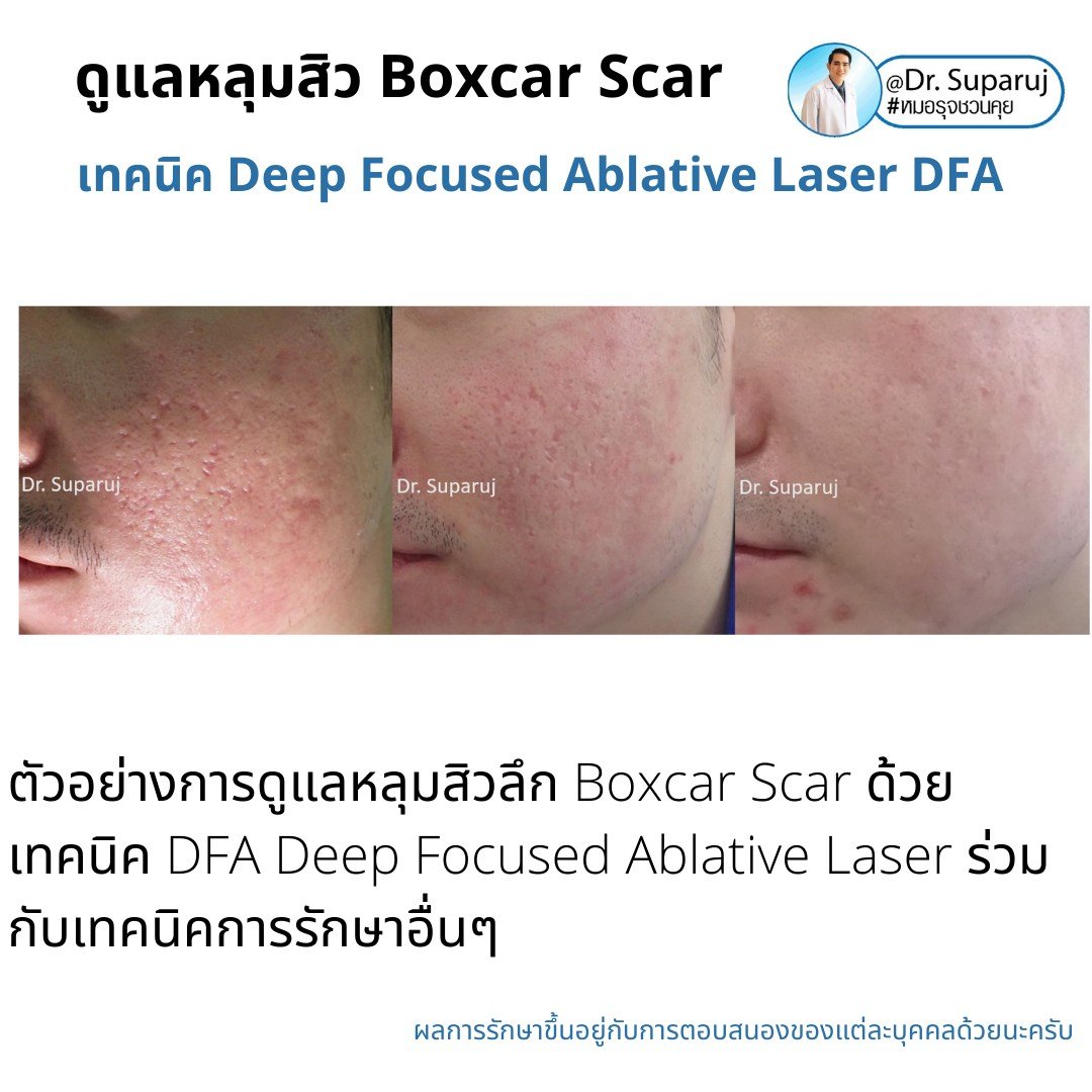 แนะนำเทคนิคดูแลหลุมสิว: เทคนิค Deep Focused Ablative Laser (DFA) ดูแลหลุมสิวลึกขอบชัดพังผืดหนา Boxcar Scar และ Linear scar แนะนำเทคนิคดูแลหลุมสิว: เทคนิค Deep Focused Ablative Laser (DFA) ดูแลหลุมสิวลึกขอบชัดพังผืดหนา Boxcar Scar และ Linear scar
