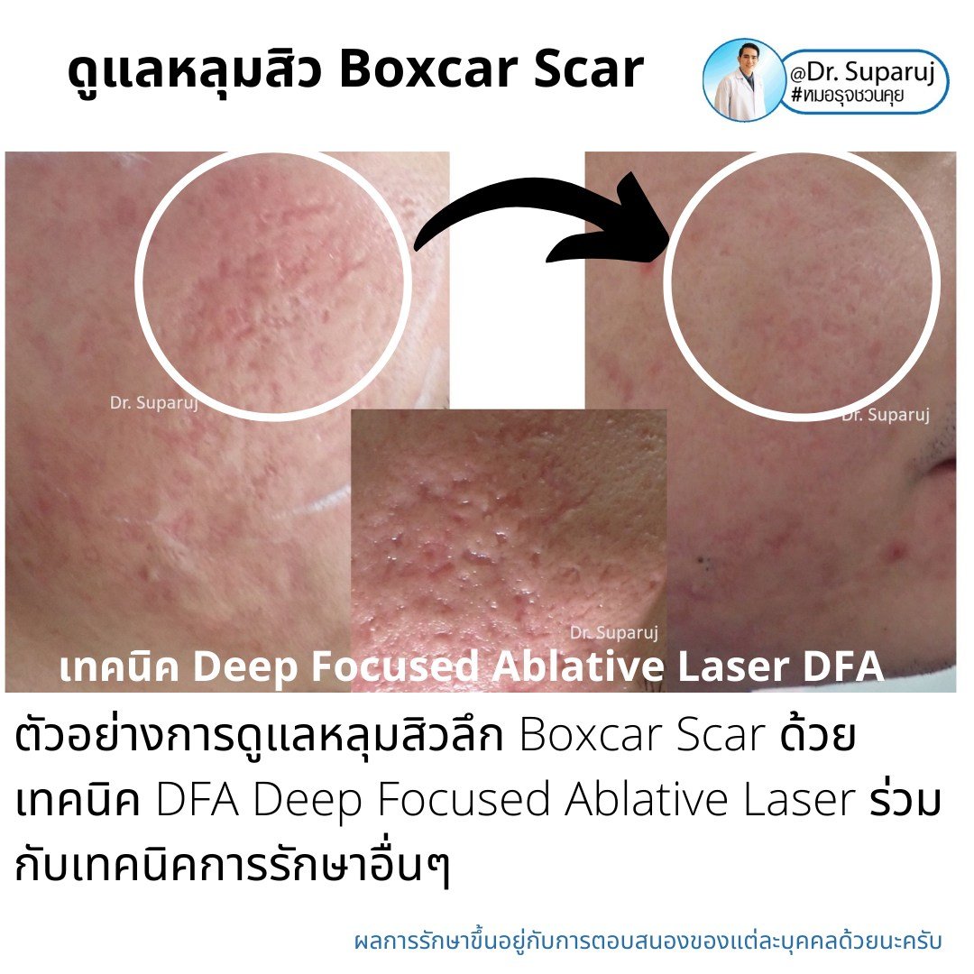 แนะนำเทคนิคดูแลหลุมสิว: เทคนิค Deep Focused Ablative Laser (DFA) ดูแลหลุมสิวลึกขอบชัดพังผืดหนา Boxcar Scar และ Linear scar แนะนำเทคนิคดูแลหลุมสิว: เทคนิค Deep Focused Ablative Laser (DFA) ดูแลหลุมสิวลึกขอบชัดพังผืดหนา Boxcar Scar และ Linear scar