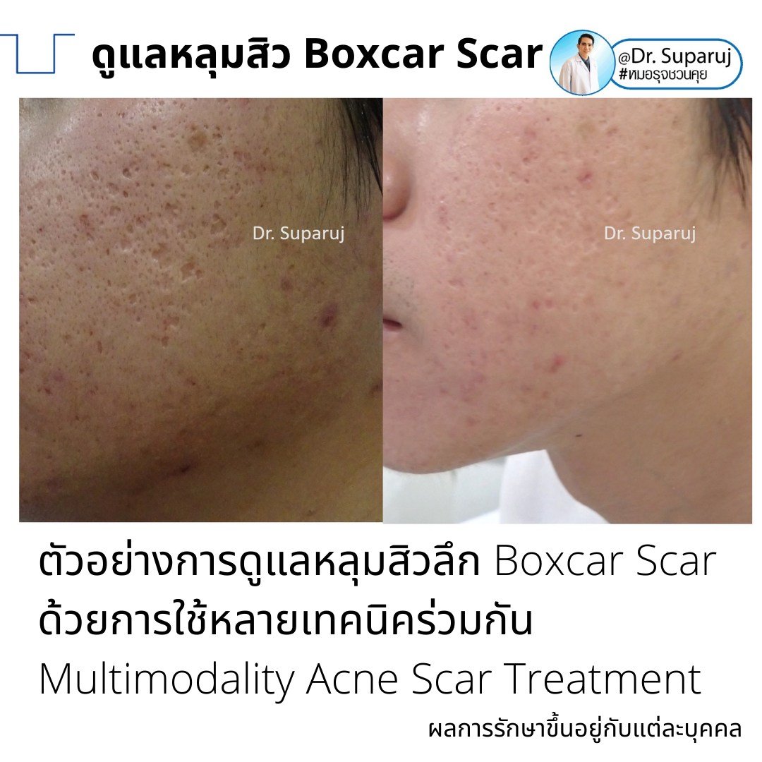 แนะนำเทคนิคดูแลหลุมสิว: เทคนิค Deep Focused Ablative Laser (DFA) ดูแลหลุมสิวลึกขอบชัดพังผืดหนา Boxcar Scar และ Linear scar แนะนำเทคนิคดูแลหลุมสิว: เทคนิค Deep Focused Ablative Laser (DFA) ดูแลหลุมสิวลึกขอบชัดพังผืดหนา Boxcar Scar และ Linear scar