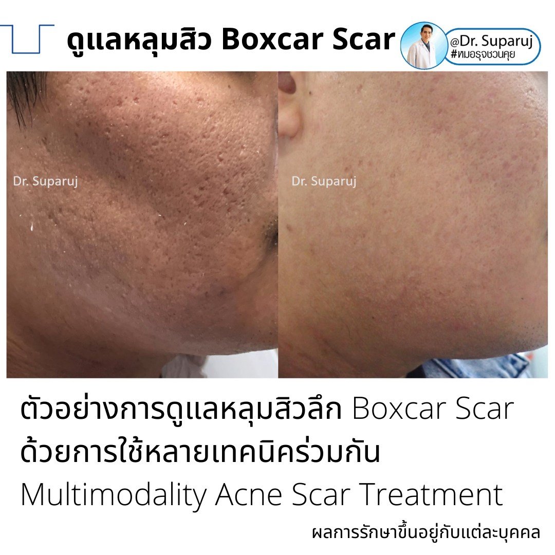 แนะนำเทคนิคดูแลหลุมสิว: เทคนิค Deep Focused Ablative Laser (DFA) ดูแลหลุมสิวลึกขอบชัดพังผืดหนา Boxcar Scar และ Linear scar