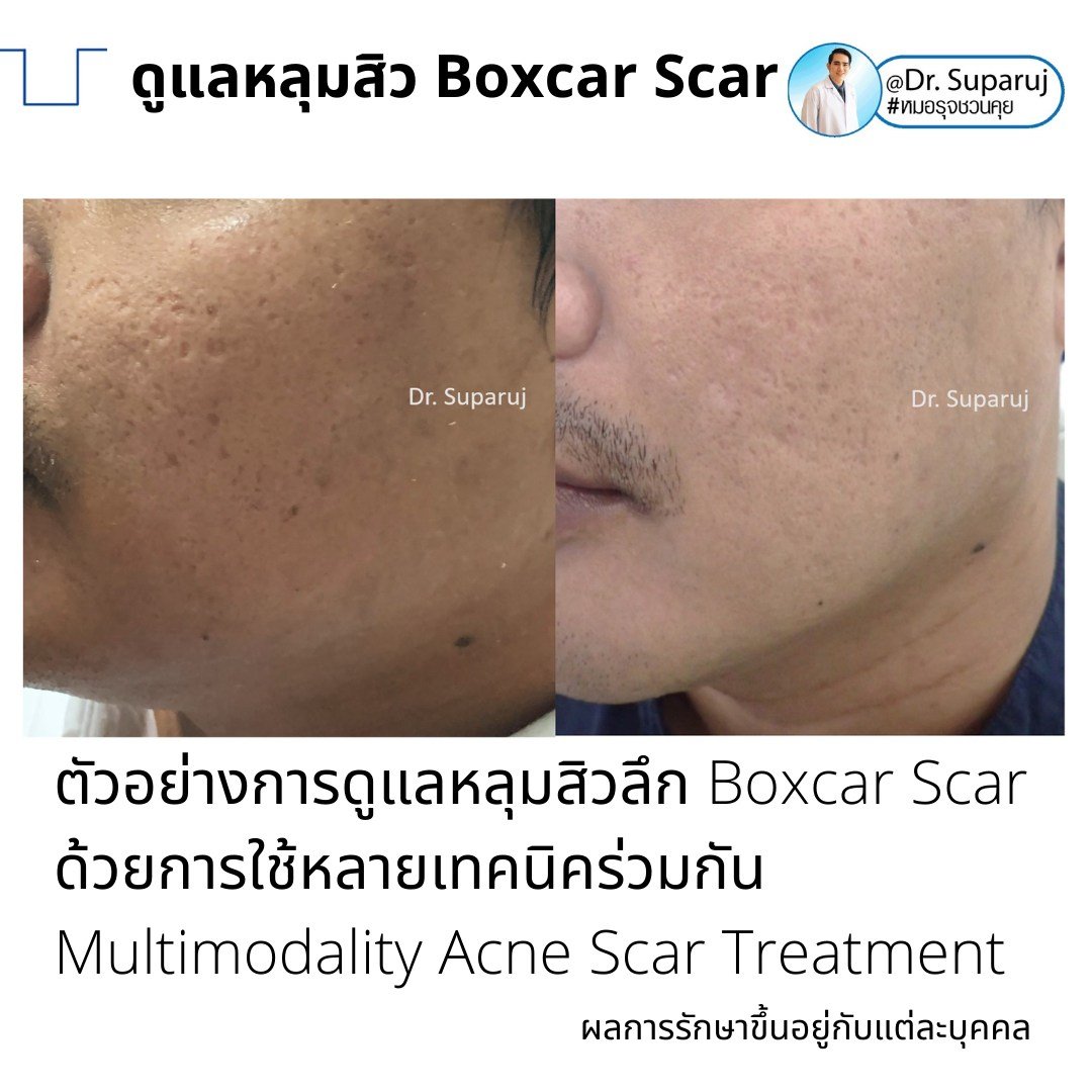 แนะนำเทคนิคดูแลหลุมสิว: เทคนิค Deep Focused Ablative Laser (DFA) ดูแลหลุมสิวลึกขอบชัดพังผืดหนา Boxcar Scar และ Linear scar