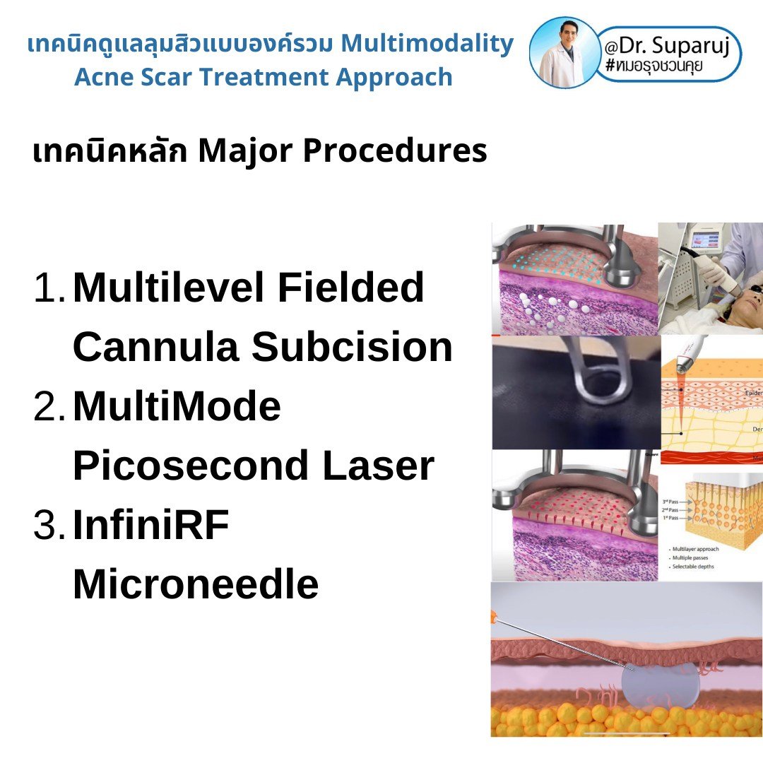 แนะนำเทคนิคดูแลหลุมสิว: เทคนิคดูแลหลุมสิวที่หมอรุจใช้บ่อย Multimodality Acne Scar Treatment Approach แนะนำเทคนิคดูแลหลุมสิว: เทคนิคดูแลหลุมสิวที่หมอรุจใช้บ่อย Multimodality Acne Scar Treatment Approach