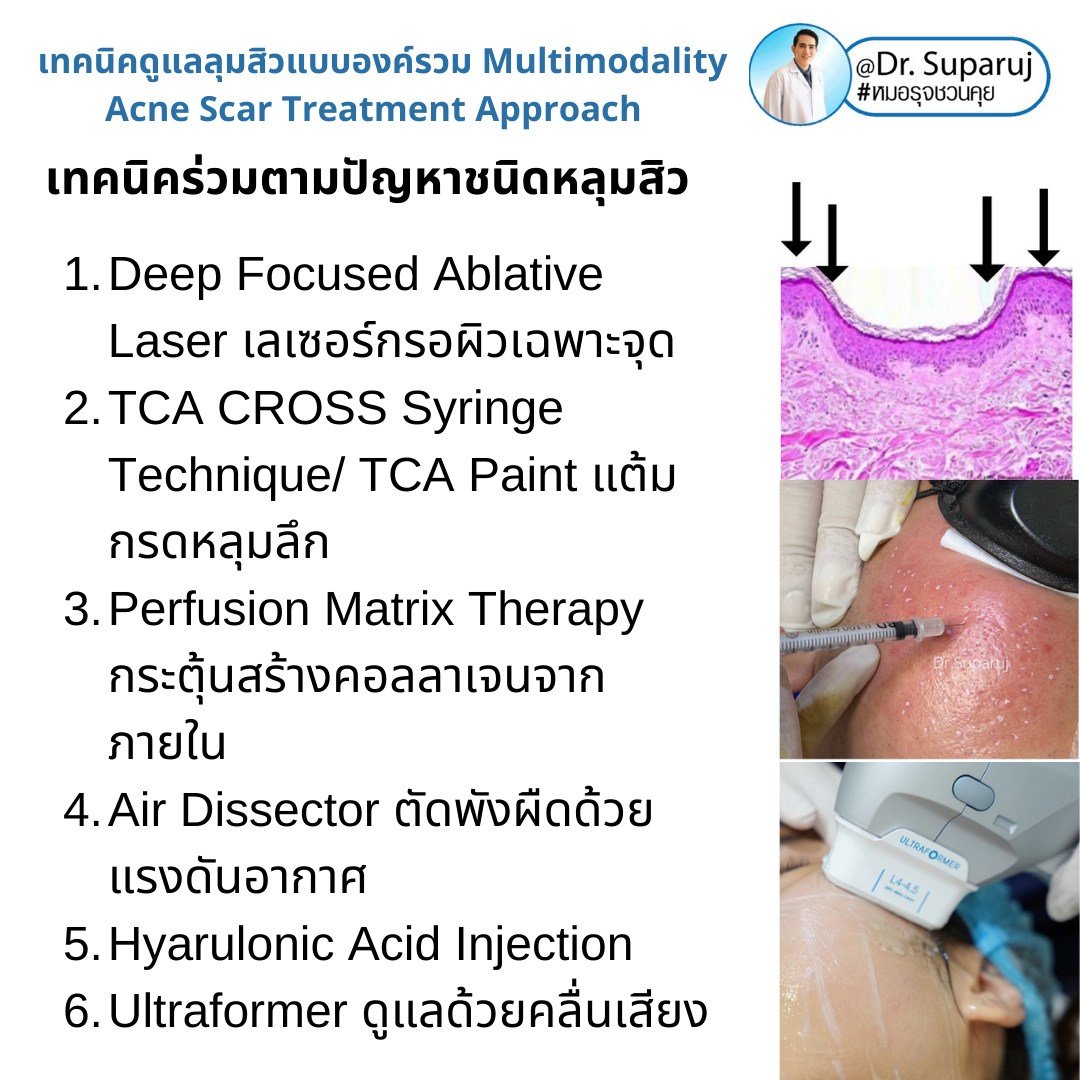 แนะนำเทคนิคดูแลหลุมสิว: เทคนิคดูแลหลุมสิวที่หมอรุจใช้บ่อย Multimodality Acne Scar Treatment Approach