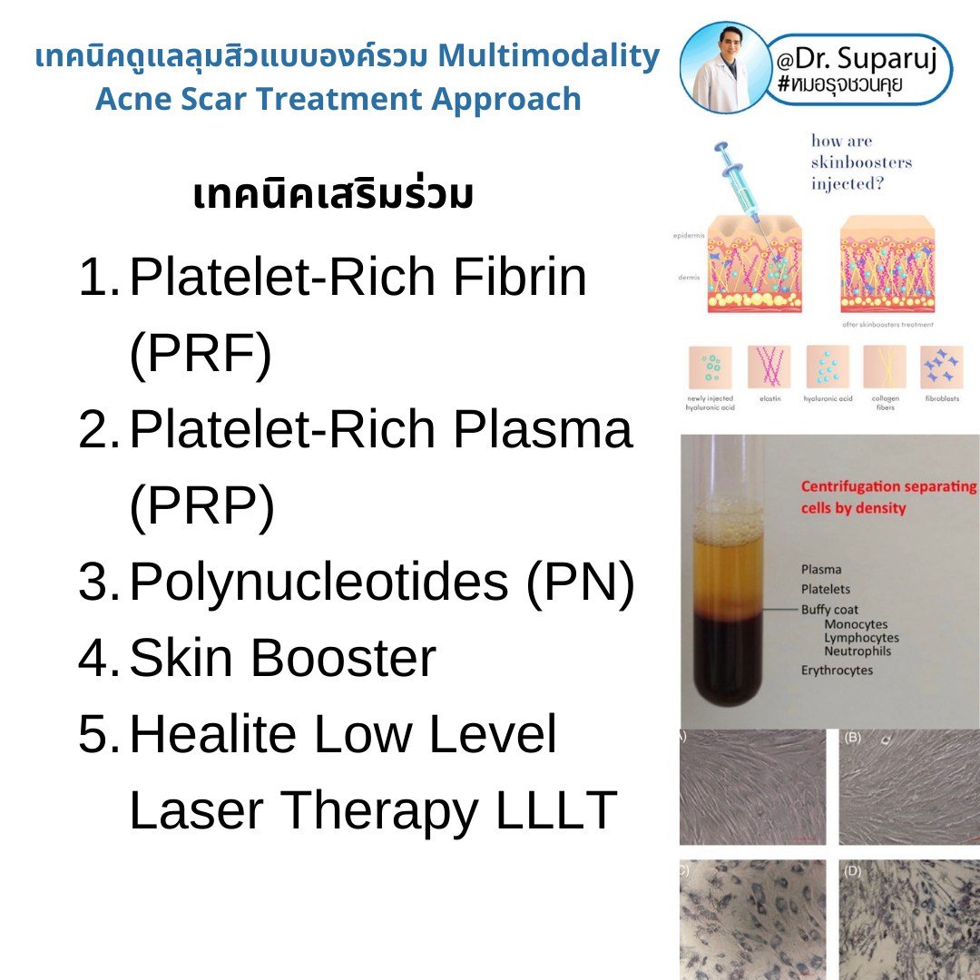 แนะนำเทคนิคดูแลหลุมสิว: เทคนิคดูแลหลุมสิวที่หมอรุจใช้บ่อย Multimodality Acne Scar Treatment Approach