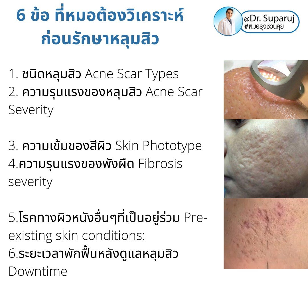 แนะนำเทคนิคดูแลหลุมสิว: เทคนิคดูแลหลุมสิวที่หมอรุจใช้บ่อย Multimodality Acne Scar Treatment Approach แนะนำเทคนิคดูแลหลุมสิว: เทคนิคดูแลหลุมสิวที่หมอรุจใช้บ่อย Multimodality Acne Scar Treatment Approach