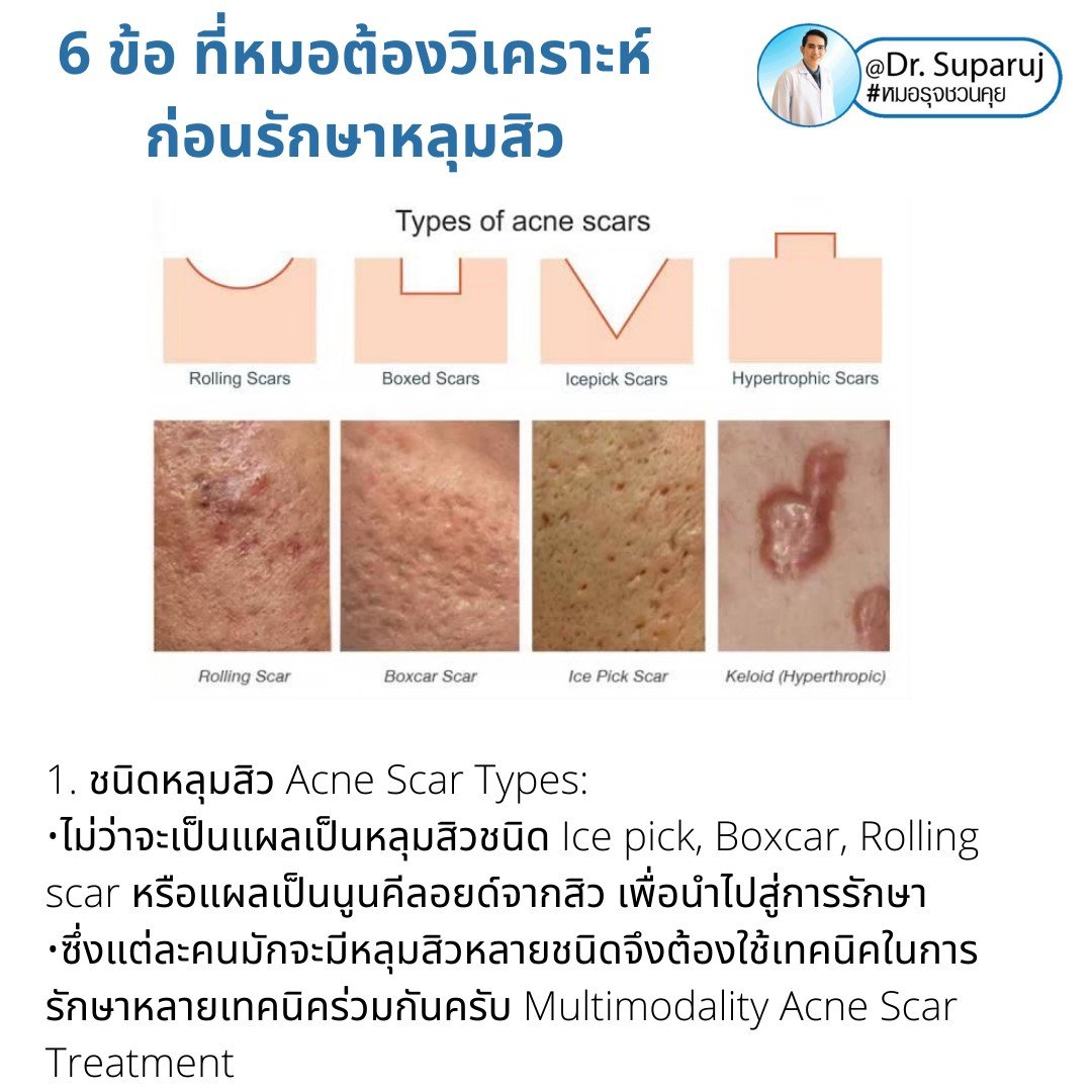 แนะนำเทคนิคดูแลหลุมสิว: เทคนิคดูแลหลุมสิวที่หมอรุจใช้บ่อย Multimodality Acne Scar Treatment Approach