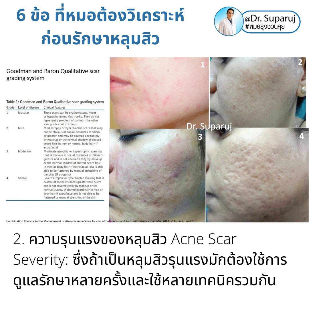แนะนำเทคนิคดูแลหลุมสิว: เทคนิคดูแลหลุมสิวที่หมอรุจใช้บ่อย Multimodality Acne Scar Treatment Approach แนะนำเทคนิคดูแลหลุมสิว: เทคนิคดูแลหลุมสิวที่หมอรุจใช้บ่อย Multimodality Acne Scar Treatment Approach