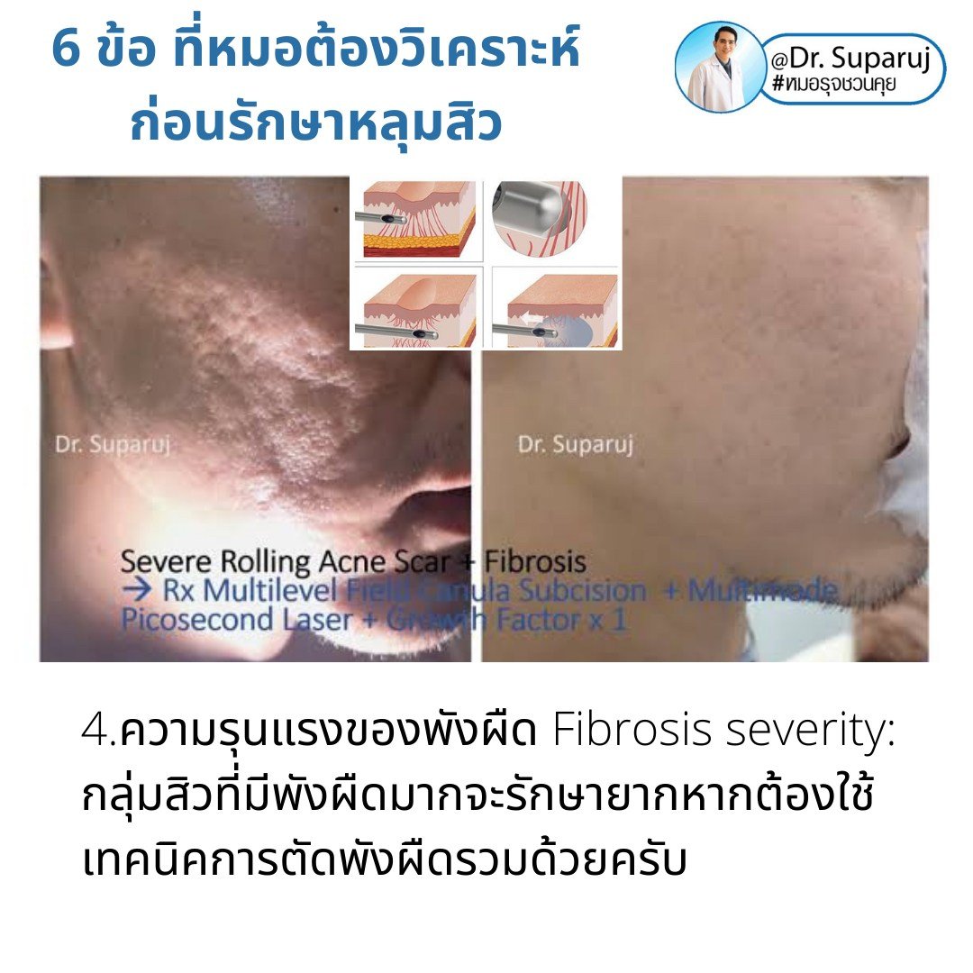 แนะนำเทคนิคดูแลหลุมสิว: เทคนิคดูแลหลุมสิวที่หมอรุจใช้บ่อย Multimodality Acne Scar Treatment Approach แนะนำเทคนิคดูแลหลุมสิว: เทคนิคดูแลหลุมสิวที่หมอรุจใช้บ่อย Multimodality Acne Scar Treatment Approach
