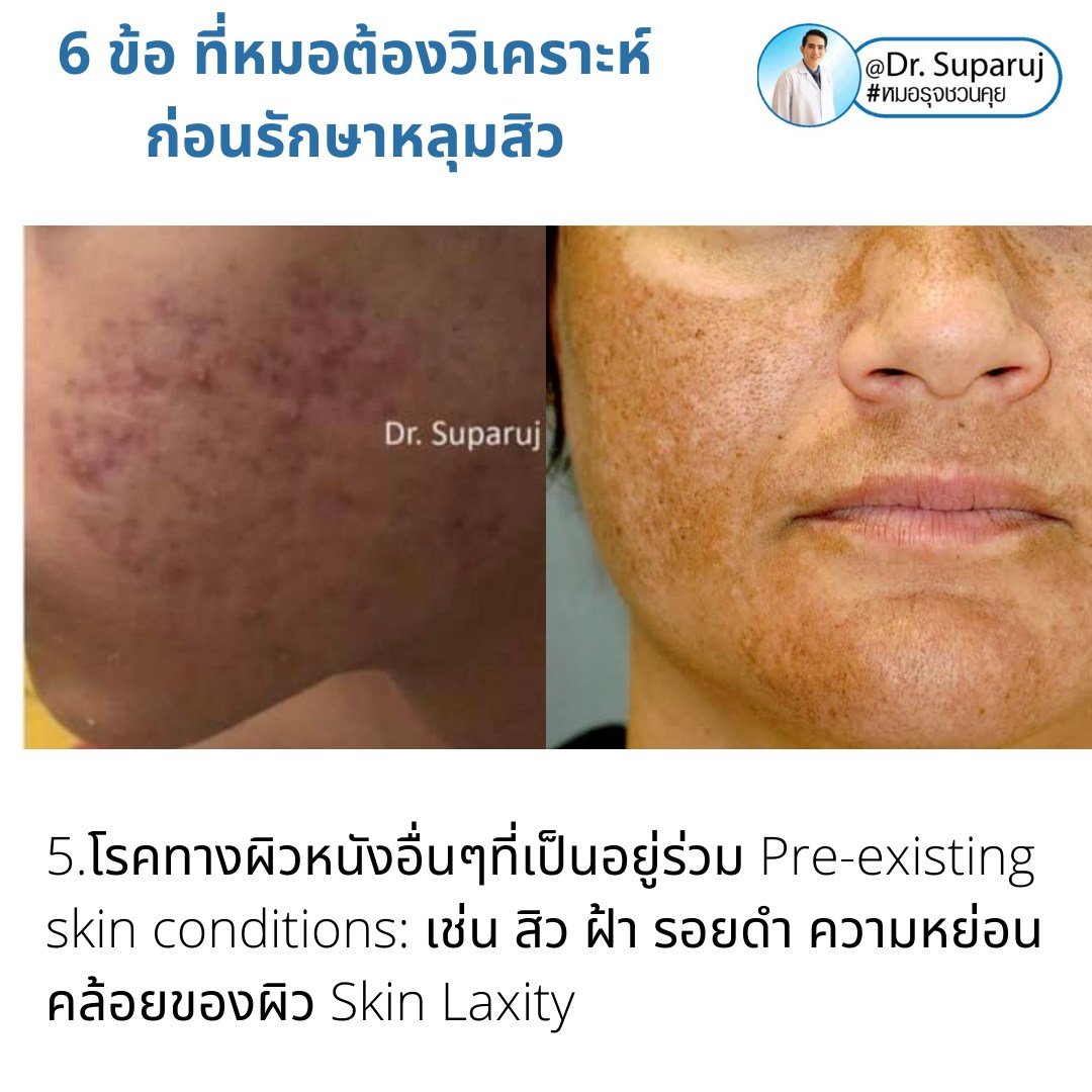 แนะนำเทคนิคดูแลหลุมสิว: เทคนิคดูแลหลุมสิวที่หมอรุจใช้บ่อย Multimodality Acne Scar Treatment Approach