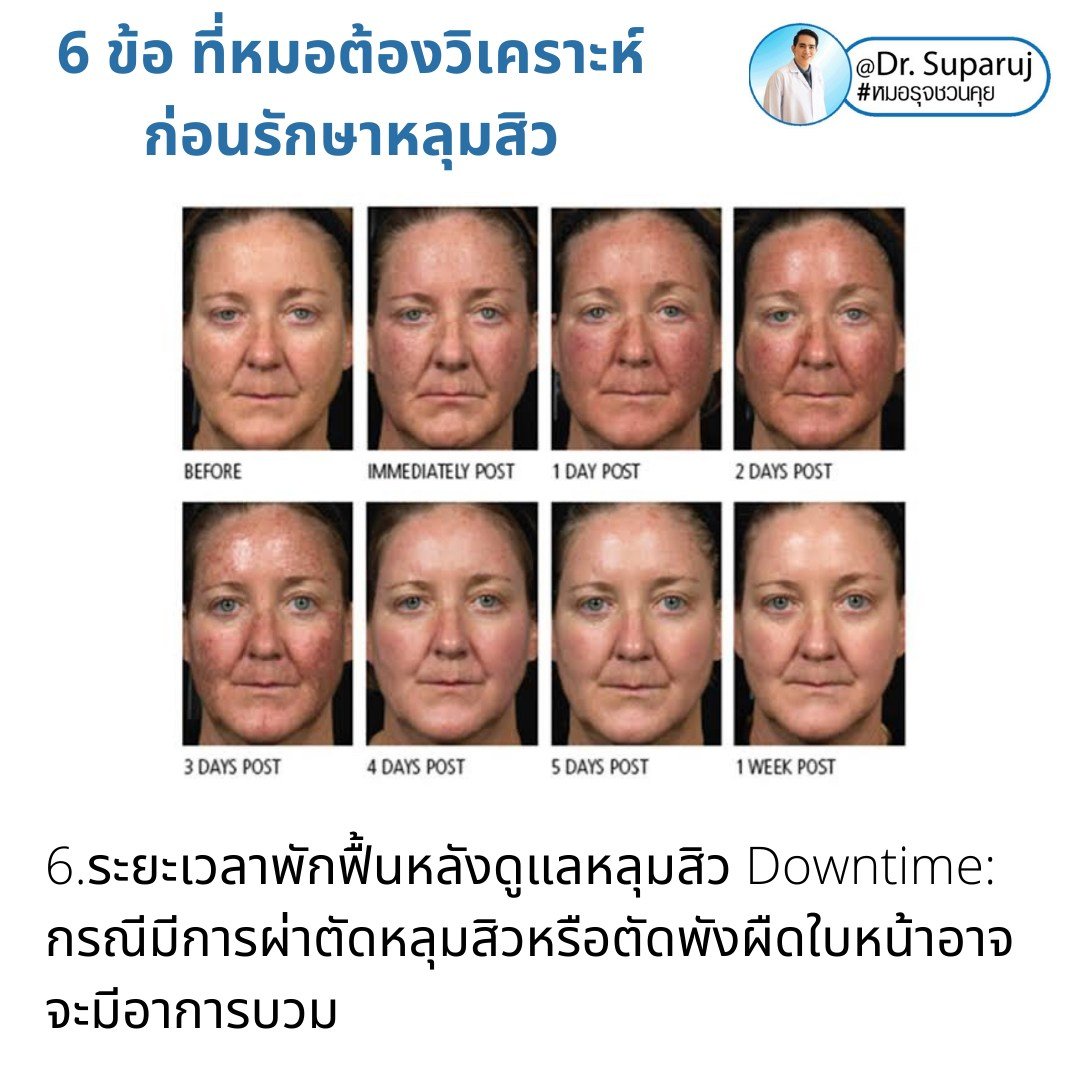 แนะนำเทคนิคดูแลหลุมสิว: เทคนิคดูแลหลุมสิวที่หมอรุจใช้บ่อย Multimodality Acne Scar Treatment Approach แนะนำเทคนิคดูแลหลุมสิว: เทคนิคดูแลหลุมสิวที่หมอรุจใช้บ่อย Multimodality Acne Scar Treatment Approach