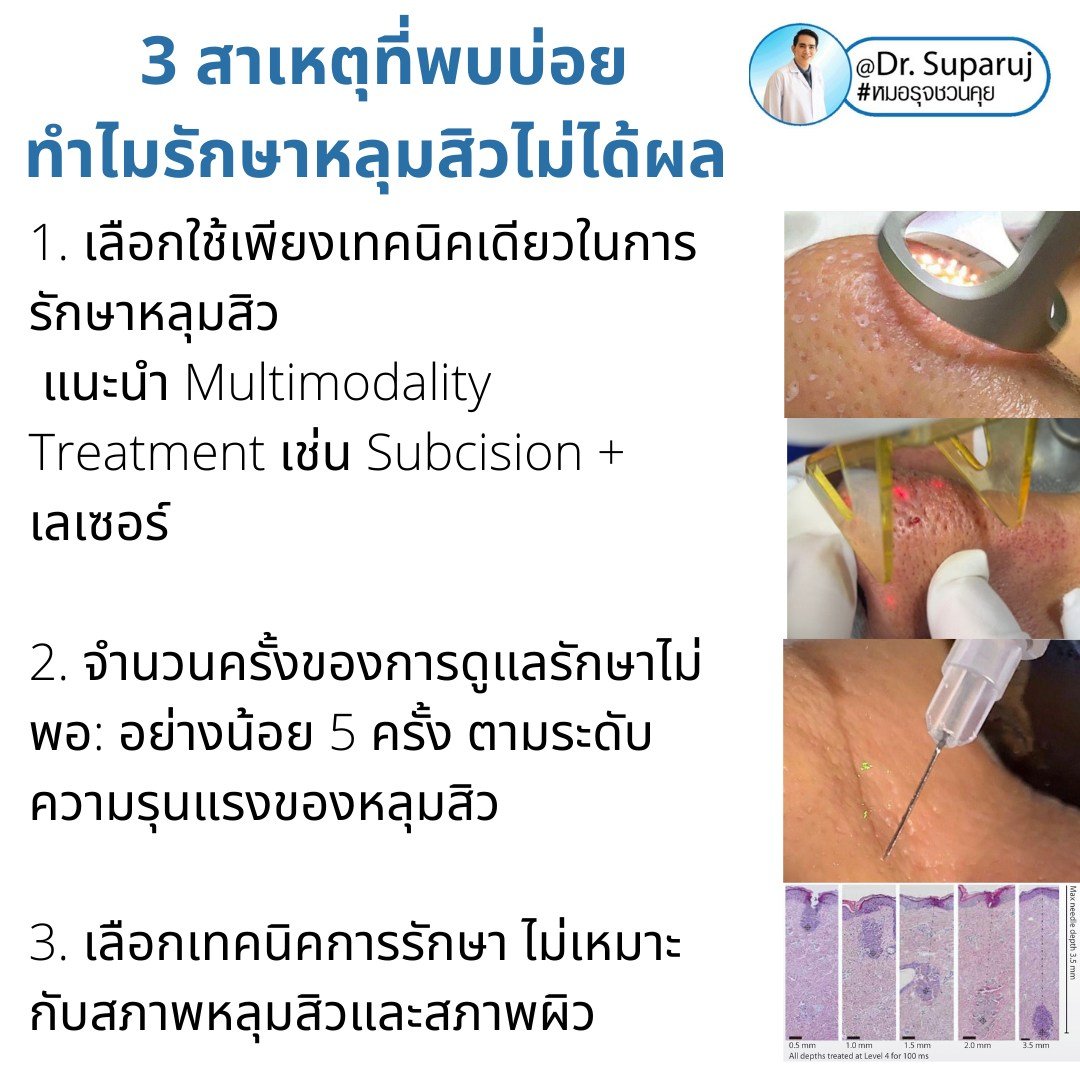 แนะนำเทคนิคดูแลหลุมสิว: เทคนิคดูแลหลุมสิวที่หมอรุจใช้บ่อย Multimodality Acne Scar Treatment Approach แนะนำเทคนิคดูแลหลุมสิว: เทคนิคดูแลหลุมสิวที่หมอรุจใช้บ่อย Multimodality Acne Scar Treatment Approach