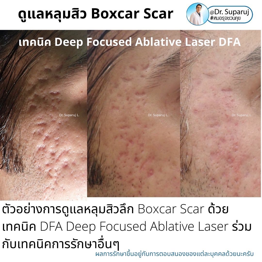 แนะนำเทคนิคดูแลหลุมสิว: เทคนิคดูแลหลุมสิวที่หมอรุจใช้บ่อย Multimodality Acne Scar Treatment Approach แนะนำเทคนิคดูแลหลุมสิว: เทคนิคดูแลหลุมสิวที่หมอรุจใช้บ่อย Multimodality Acne Scar Treatment Approach