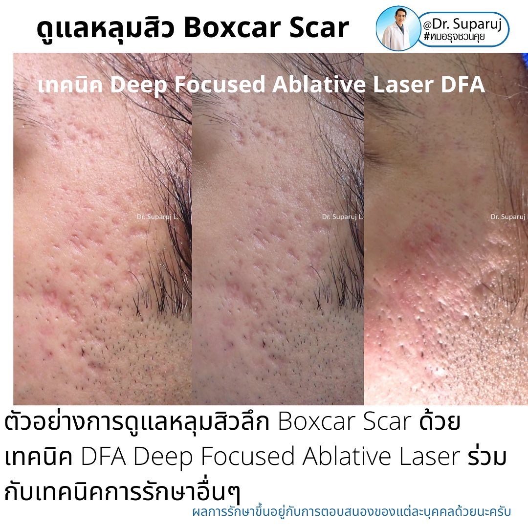 แนะนำเทคนิคดูแลหลุมสิว: เทคนิคดูแลหลุมสิวที่หมอรุจใช้บ่อย Multimodality Acne Scar Treatment Approach