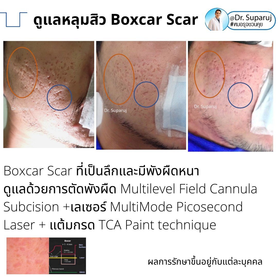 แนะนำเทคนิคดูแลหลุมสิว: เทคนิคดูแลหลุมสิวที่หมอรุจใช้บ่อย Multimodality Acne Scar Treatment Approach แนะนำเทคนิคดูแลหลุมสิว: เทคนิคดูแลหลุมสิวที่หมอรุจใช้บ่อย Multimodality Acne Scar Treatment Approach