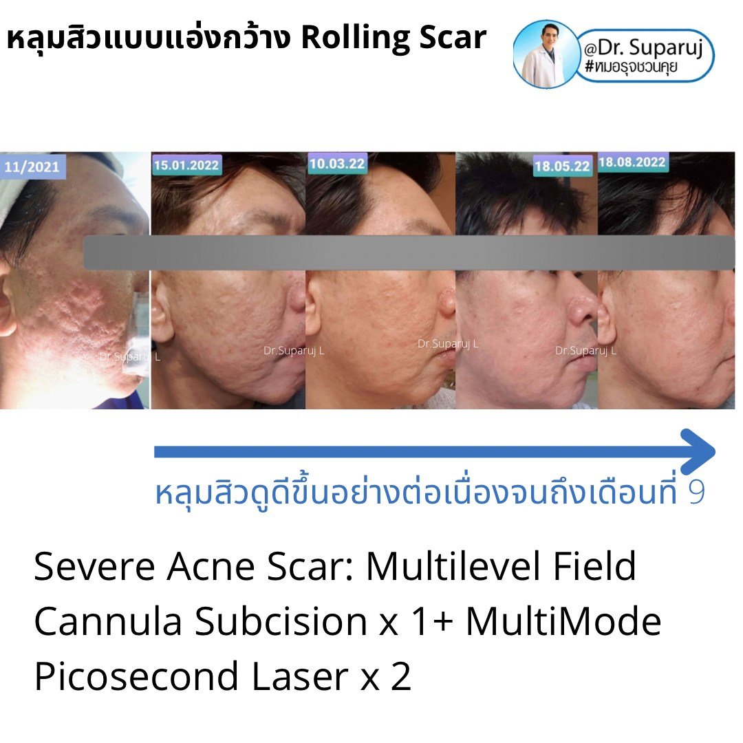 Picosecond Laser ช่วยดูแลหลุมสิวดีขึ้นต่อเนื่องถึงเดือนที่ 9 หลังการรักษาครั้งสุดท้าย Picosecond Laser ช่วยดูแลหลุมสิวดีขึ้นต่อเนื่องถึงเดือนที่ 9 หลังการรักษาครั้งสุดท้าย