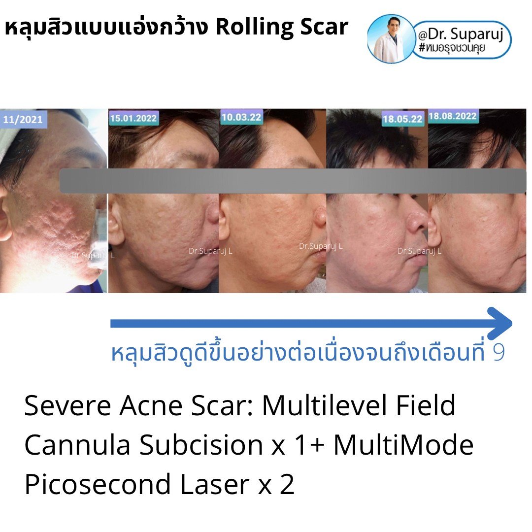 Picosecond Laser ช่วยดูแลหลุมสิวดีขึ้นต่อเนื่องถึงเดือนที่ 9 หลังการรักษาครั้งสุดท้าย