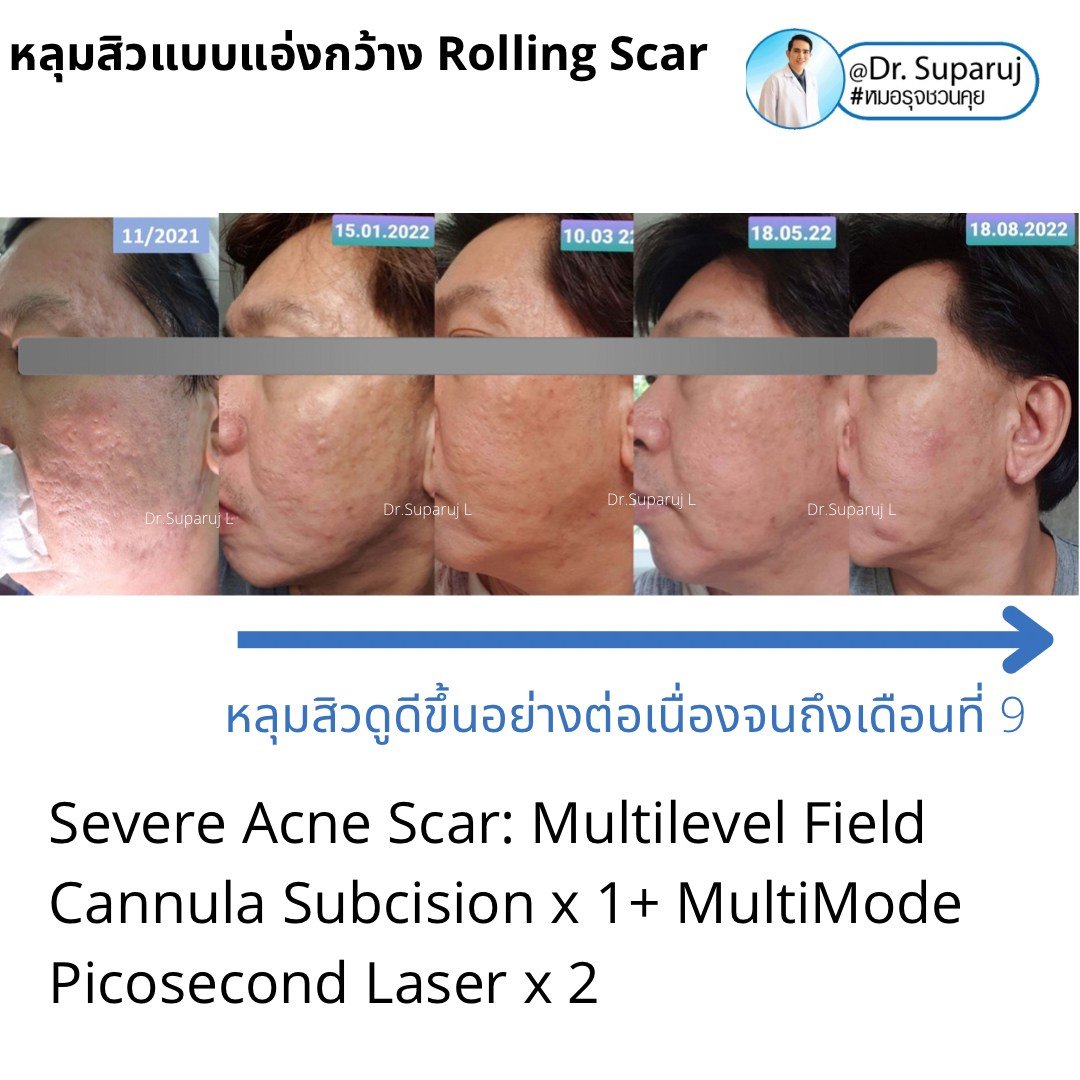 Picosecond Laser ช่วยดูแลหลุมสิวดีขึ้นต่อเนื่องถึงเดือนที่ 9 หลังการรักษาครั้งสุดท้าย Picosecond Laser ช่วยดูแลหลุมสิวดีขึ้นต่อเนื่องถึงเดือนที่ 9 หลังการรักษาครั้งสุดท้าย
