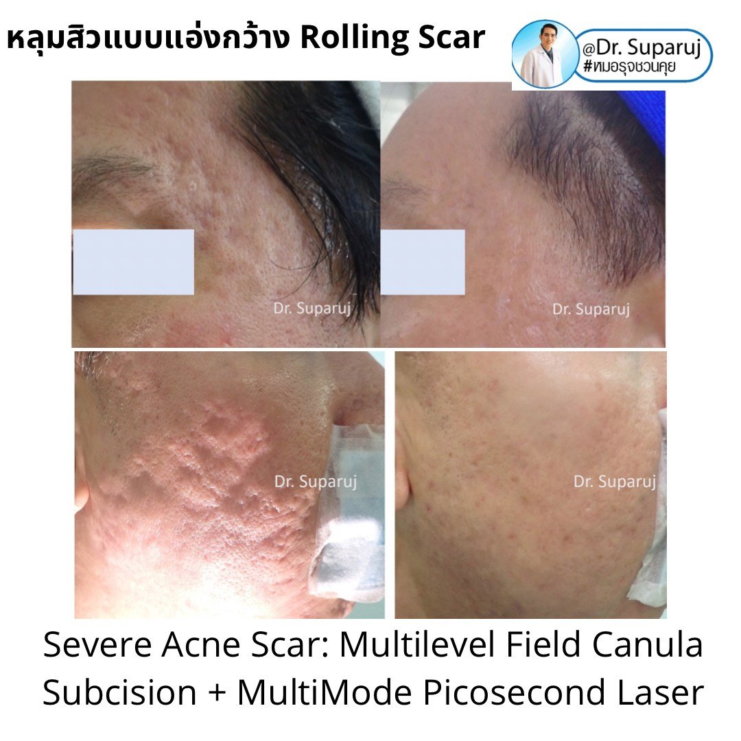 Picosecond Laser ช่วยดูแลหลุมสิวดีขึ้นต่อเนื่องถึงเดือนที่ 9 หลังการรักษาครั้งสุดท้าย